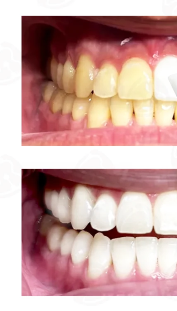 2 Minute Teeth Whitening Pen